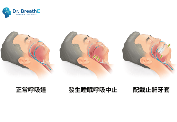 止鼾牙套原理