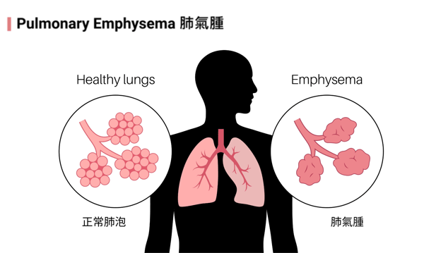 COPD-3