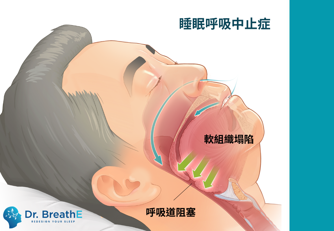 睡眠呼吸中止症