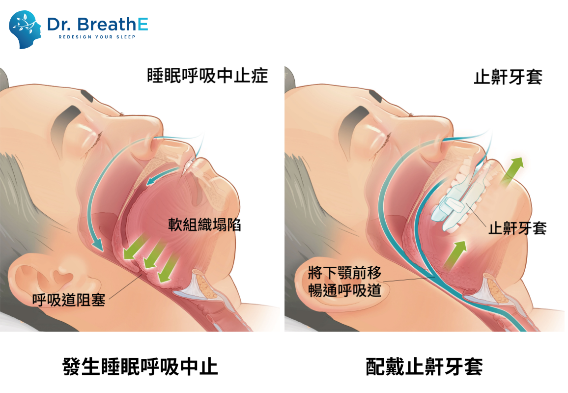 止鼾牙套效果